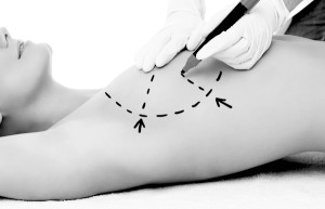 Breast Lift